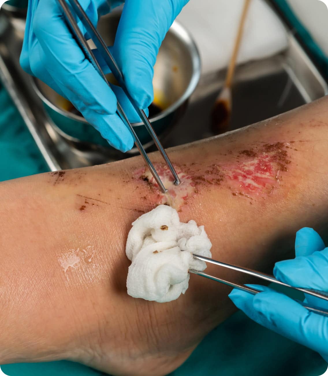 abrasion treatment options