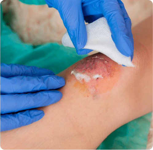 non-healing, infected abrasions