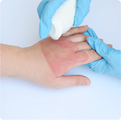 wound care for burns in Dallas