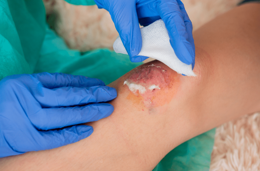 acute wound care treatments