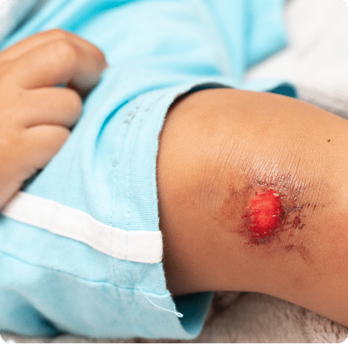 avulsions and wound care