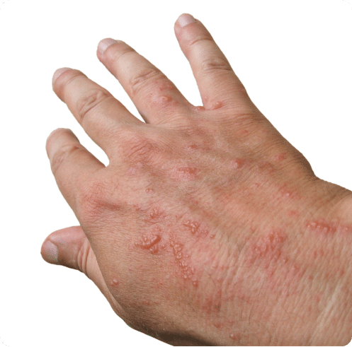 chemical burns and metacure wound care treatment