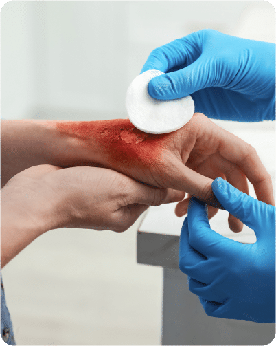 wound care after burn injury