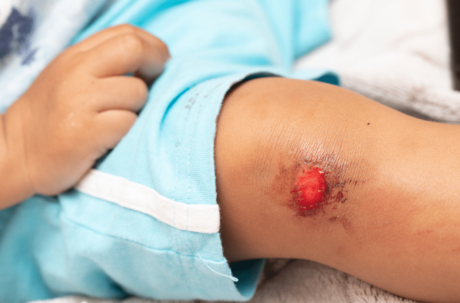 Avulsions and wound care