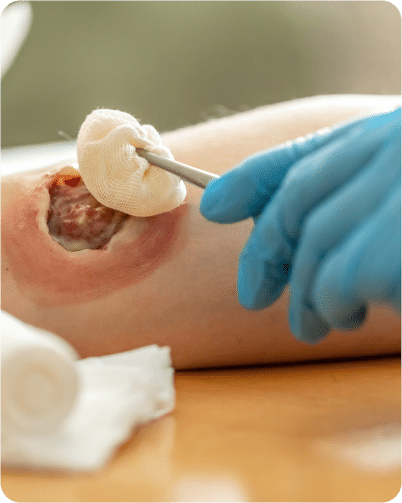 pressure ulcers and wound care